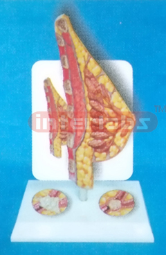 TYPE MANARY GLAND TUMOR MODEL WITH DESCRIPTION PLATE